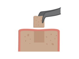 Dental Implant Surgery
