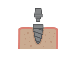Dental Implant Surgery