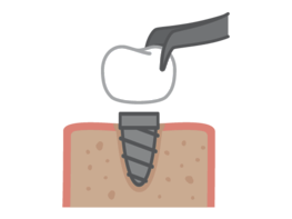 Dental Implant Surgery