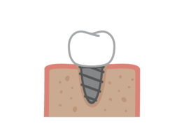 Dental Implant Surgery