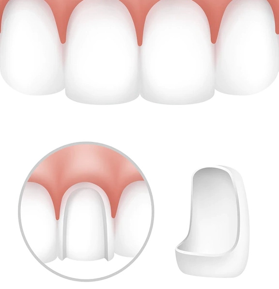 Dental Veneers