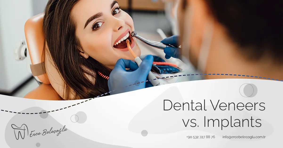 Dental Veneers vs. Implants