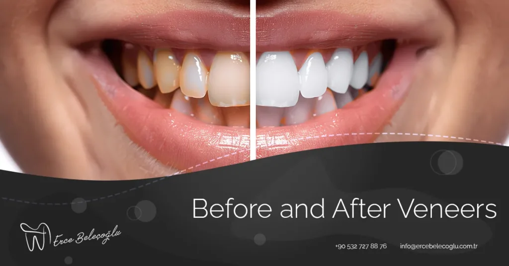 Before and After Veneers