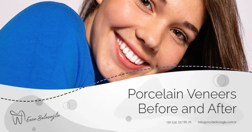 Porcelain Veneers Before and After