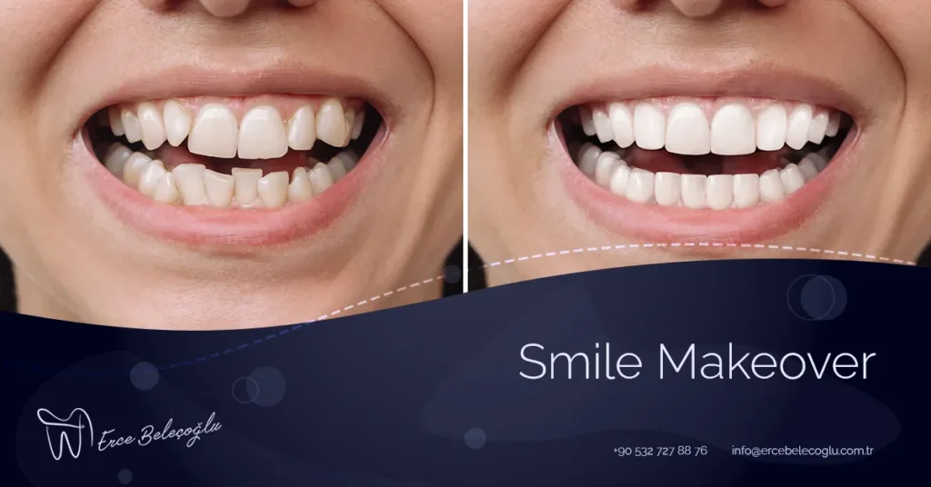 Smile Makeover