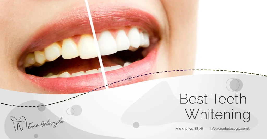 Best Teeth Whitening
