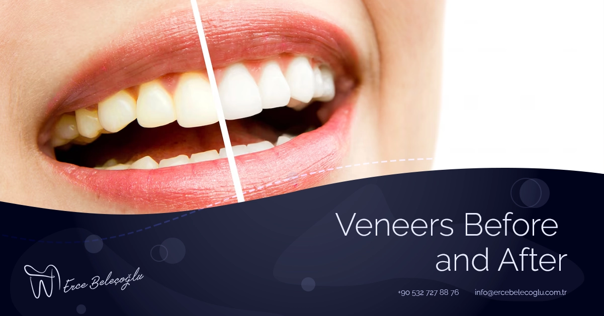 Veneers Before and After
